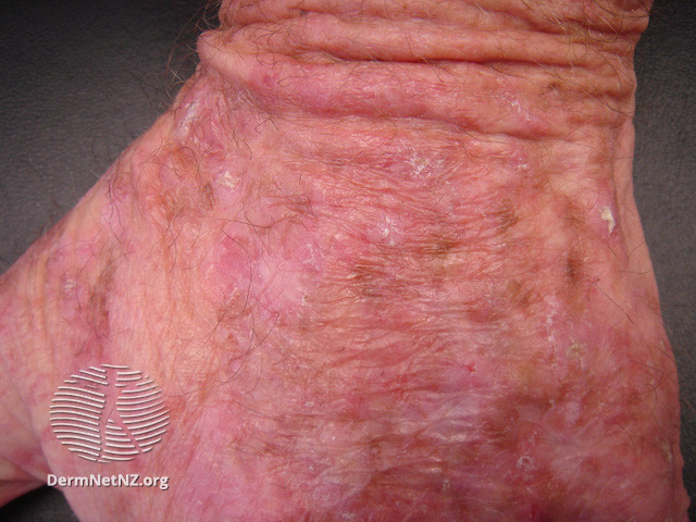 File:Actinic keratoses affecting the hands (DermNet NZ lesions-ak-hands-297).jpg