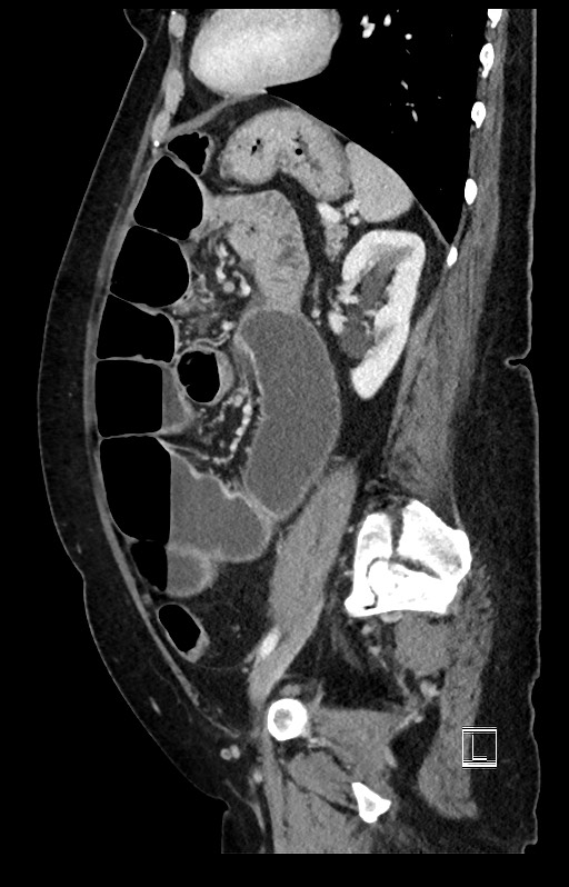 Active Crohn disease (Radiopaedia 59394-66750 Sagittal C+ portal venous phase 19).jpg