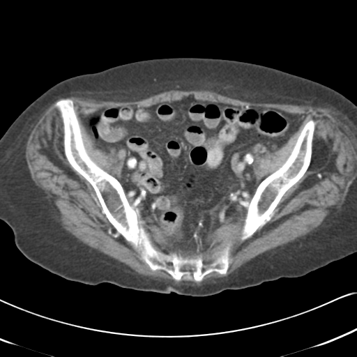 File:Active bleeding from duodenal ulcer with embolization (Radiopaedia 34216-35481 C 52).png