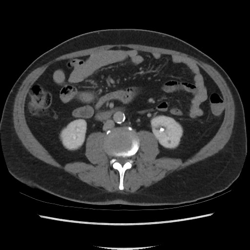 File:Active colonic bleed on CT (Radiopaedia 49765-55025 Axial C+ delayed 43).jpg