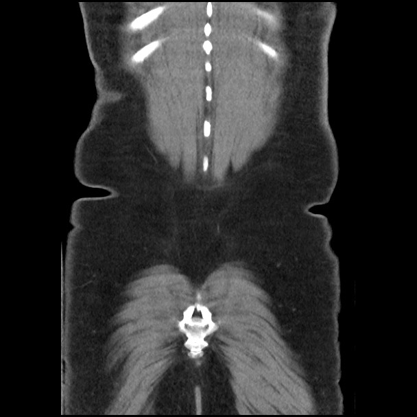 Active colonic bleed on CT (Radiopaedia 49765-55025 Coronal non-contrast 51).jpg