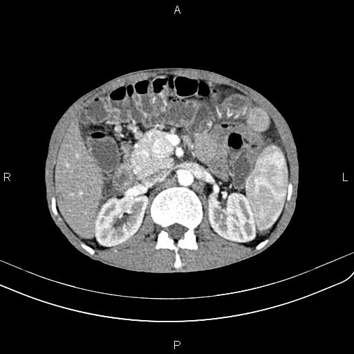 Active crohn disease (Radiopaedia 87133-103397 Axial C+ arterial phase 39).jpg