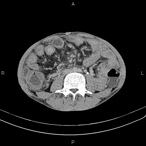 Active crohn disease (Radiopaedia 87133-103397 Axial C+ delayed 34).jpg