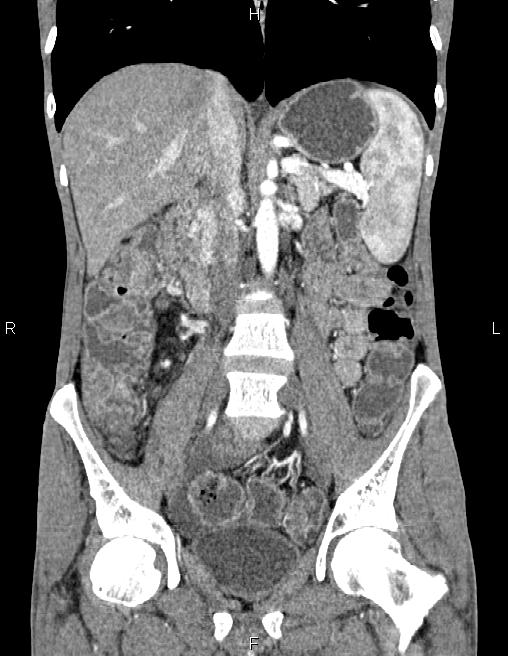 Active crohn disease (Radiopaedia 87133-103397 Coronal C+ arterial phase 34).jpg