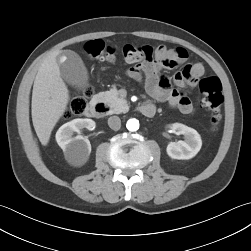 File:Active diverticular hemorrhage (Radiopaedia 39415-41725 Axial C+ arterial phase 27).png