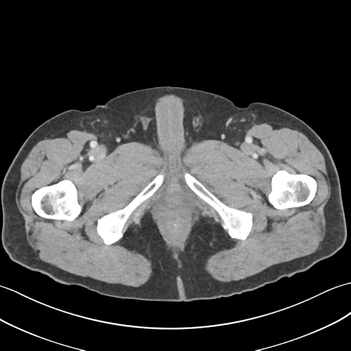 File:Active diverticular hemorrhage (Radiopaedia 39415-41725 Axial C+ portal venous phase 78).png