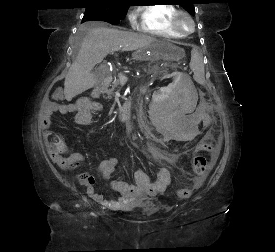 Active renal extravasation with large subcapsular and retroperitoneal hemorrhage (Radiopaedia 60975-68796 Coronal C+ arterial phase 60).jpg
