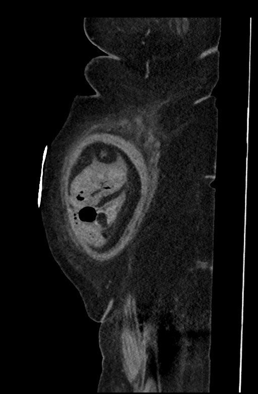 Active renal extravasation with large subcapsular and retroperitoneal hemorrhage (Radiopaedia 60975-68796 Sagittal C+ portal venous phase 197).jpg