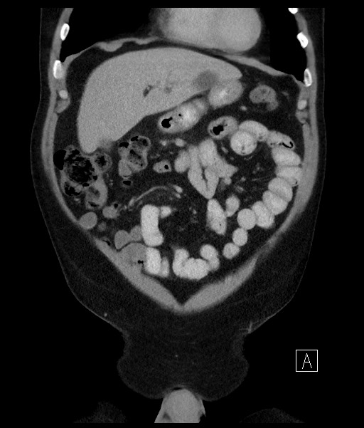 Acute-on-chronic pancreatitis (Radiopaedia 67286-76656 Coronal C+ portal venous phase 25).jpg