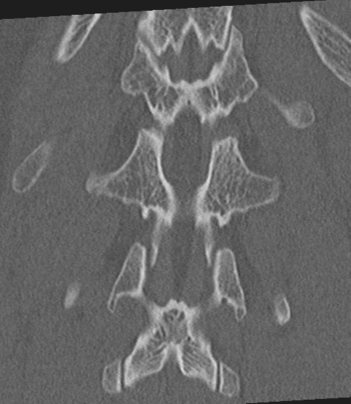 Acute L1 burst compression fracture (Radiopaedia 34430-35755 Coronal bone window 45).png