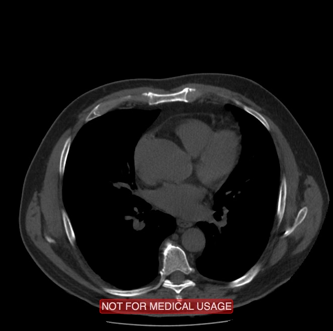 Acute aortic dissection - Stanford type A (Radiopaedia 40661-43285 Axial non-contrast 33).jpg