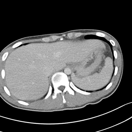 Acute appendicitis (Radiopaedia 32614-33572 Axial C+ portal venous phase 8).jpg