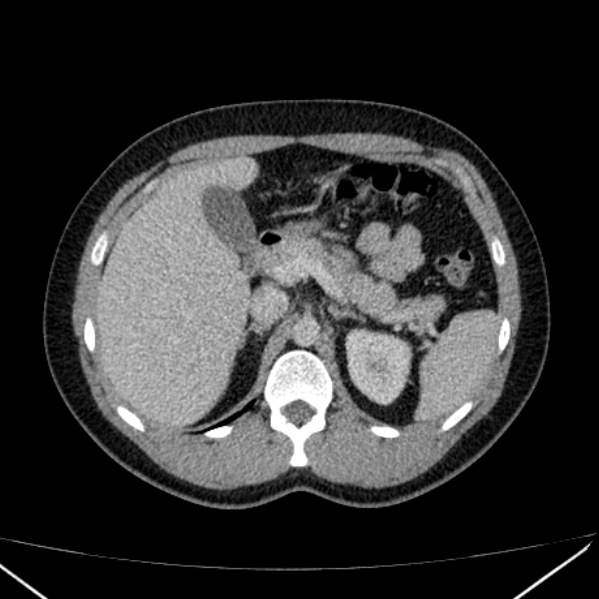 Acute appendicitis (Radiopaedia 38255-40270 Axial C+ portal venous phase 29).jpg
