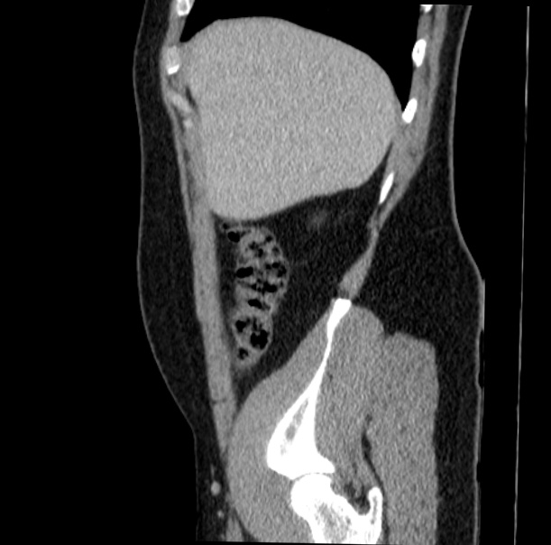Acute appendicitis (Radiopaedia 38255-40270 Sagittal C+ portal venous phase 16).jpg