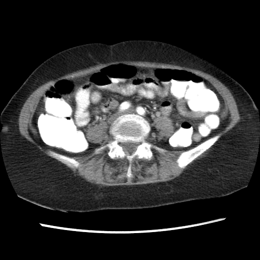 File:Acute appendicitis (Radiopaedia 52672-58589 Axial C+ arterial phase 8).jpg