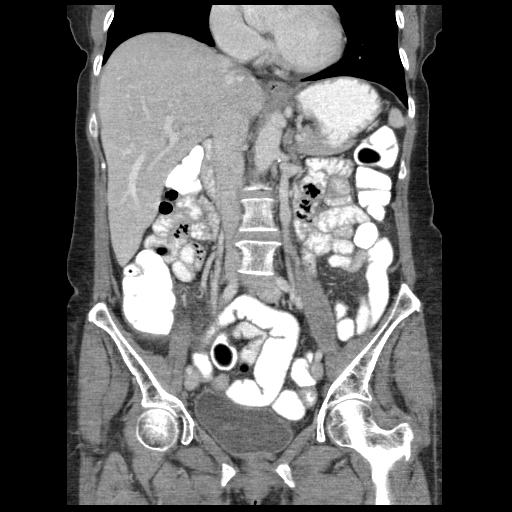 Acute appendicitis (Radiopaedia 52672-58589 Coronal C+ portal venous phase 52).jpg