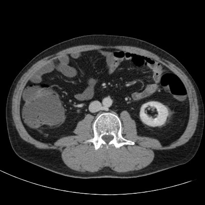 Acute appendicitis (Radiopaedia 66513-75790 Axial C+ portal venous phase 40).jpg