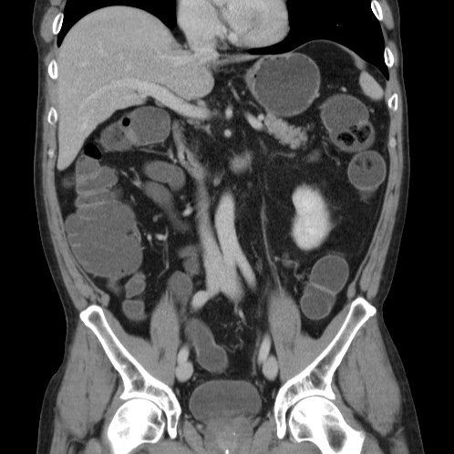 Acute appendicitis (Radiopaedia 66513-75790 Coronal C+ portal venous phase 37).jpg