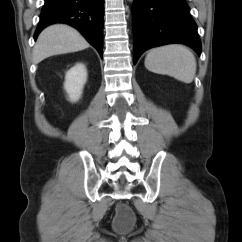 Acute appendicitis (Radiopaedia 66513-75790 Coronal C+ portal venous phase 70).jpg