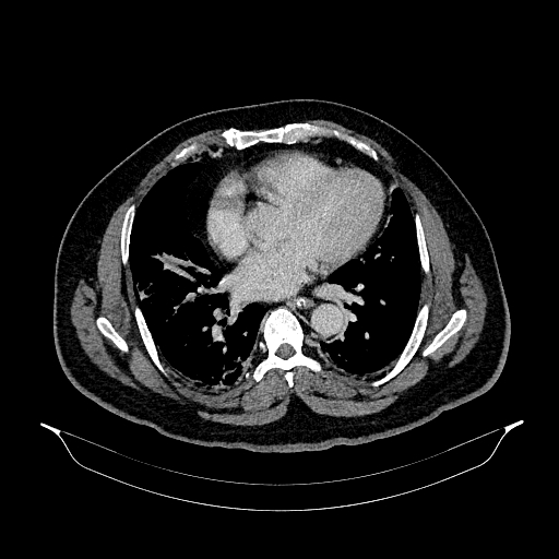 File:Acute appendicitis (Radiopaedia 79950-93224 Axial C+ portal venous phase 3).jpg