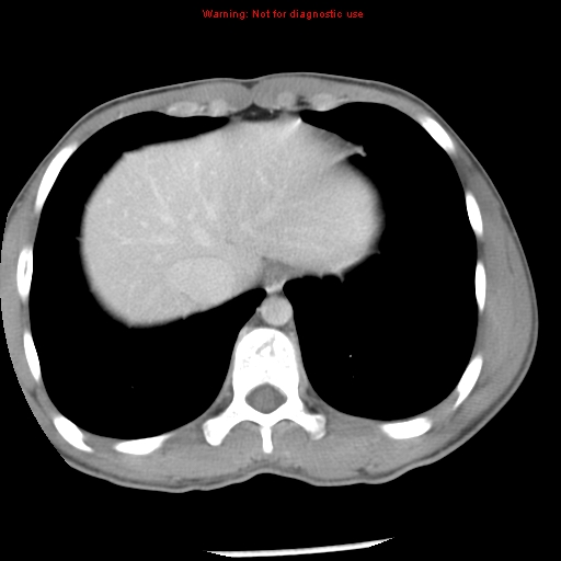 Acute appendicitis (Radiopaedia 8195-9045 Axial C+ portal venous phase 8).jpg