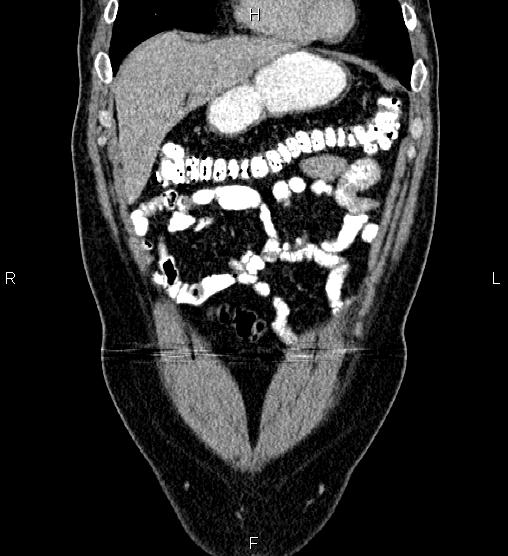 Acute appendicitis (Radiopaedia 84780-100240 Coronal C+ portal venous phase 15).jpg