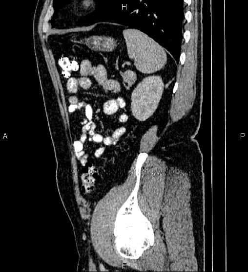 File:Acute appendicitis (Radiopaedia 84780-100240 Sagittal C+ portal venous phase 83).jpg