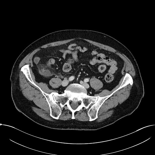 File:Acute appendicitis - large appendicoliths (Radiopaedia 61805-69820 Axial C+ portal venous phase 91).jpg