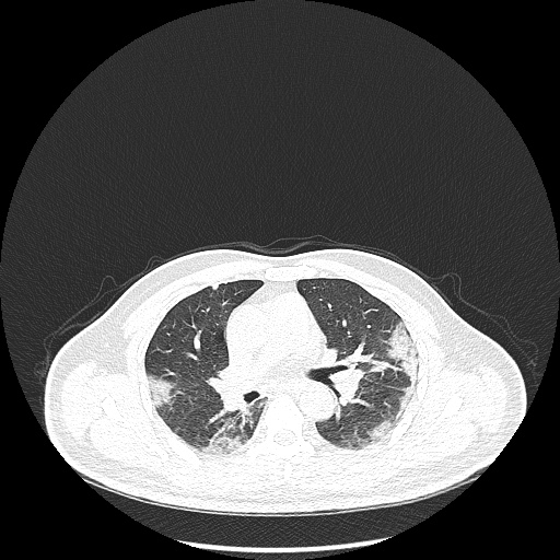 Acute appendicitis and COVID 19 pneumonia (Radiopaedia 76604-88380 Axial lung window 25).jpg