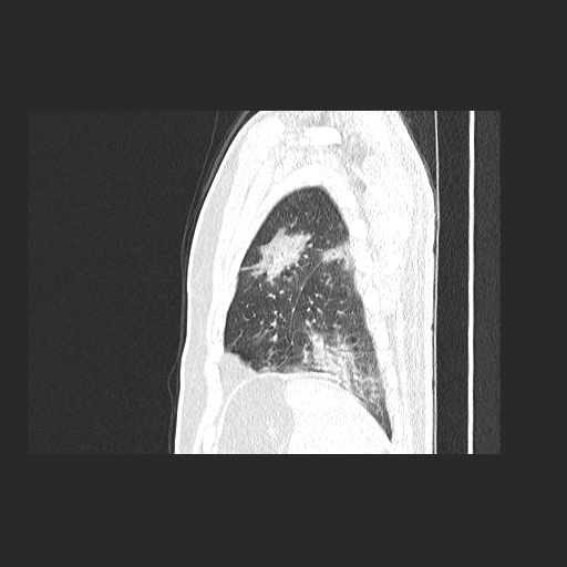 File:Acute appendicitis and COVID 19 pneumonia (Radiopaedia 76604-88380 Sagittal lung window 80).jpg