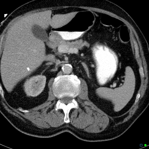 File:Acute appendicitis arising from a malrotated cecum (Radiopaedia 19970-19997 Axial C+ portal venous phase 3).jpg