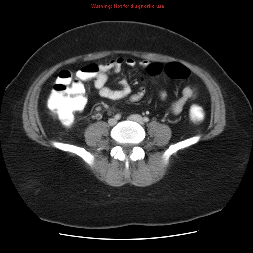Acute appendicitis complicated by ovarian vein thrombophlebitis (Radiopaedia 16172-15851 Axial C+ portal venous phase 60).jpg