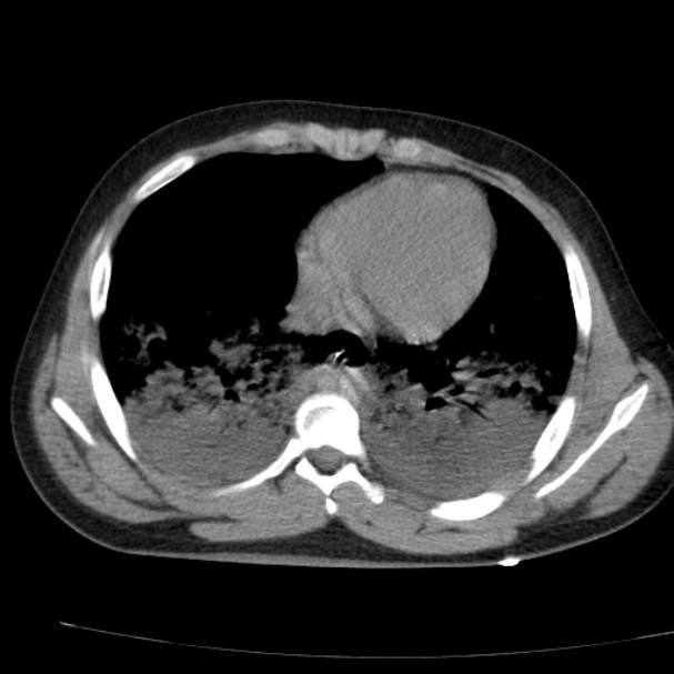 Acute aspiration pneumonitis (Radiopaedia 33605-34703 Axial non-contrast 59).jpg