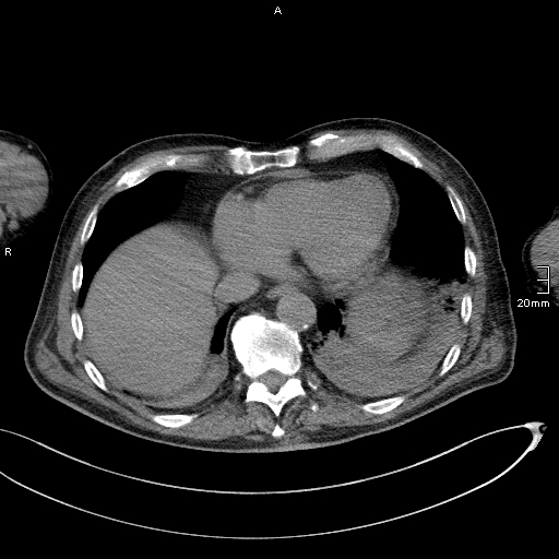 Acute aspiration pneumonitis (Radiopaedia 55642-62166 Axial liver window 49).jpg