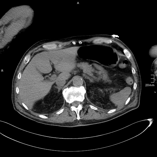 File:Acute aspiration pneumonitis (Radiopaedia 55642-62166 Axial liver window 61).jpg