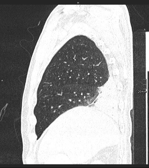 Acute aspiration pneumonitis (Radiopaedia 55642-62166 Sagittal lung window 124).jpg