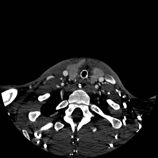 Acute basilar artery occlusion (Radiopaedia 43582-46985 Axial C+ arterial phase 274).jpg
