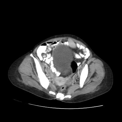 File:Acute calculous cholecystitis in patient with osteopetrosis (Radiopaedia 77871-90159 Axial C+ portal venous phase 67).jpg