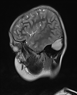 File:Acute cerebellar ataxia (Radiopaedia 61487-69446 Sagittal T2 13).jpg
