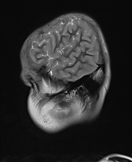 File:Acute cerebellar ataxia (Radiopaedia 61487-69446 Sagittal T2 14).jpg