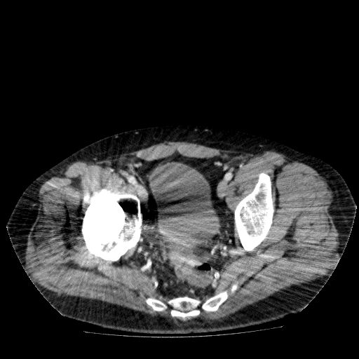 File:Acute cholecystitis and incidental left sided IVC (Radiopaedia 49352-54459 Axial C+ portal venous phase 137).jpg