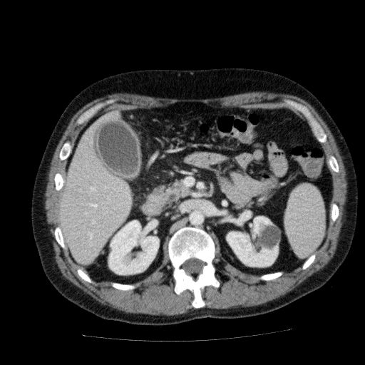 File:Acute cholecystitis and incidental left sided IVC (Radiopaedia 49352-54459 Axial C+ portal venous phase 60).jpg
