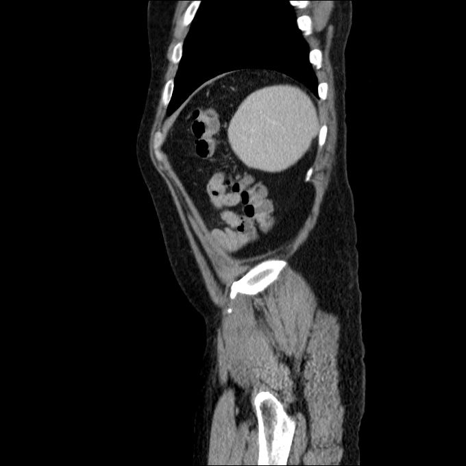 Acute cholecystitis and incidental left sided IVC (Radiopaedia 49352-54459 Sagittal C+ portal venous phase 18).jpg