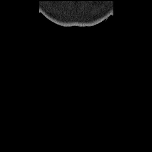 Acute cholecystitis and ureteric colic (Radiopaedia 42330-45444 Coronal prone 110).jpg