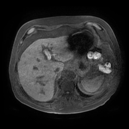 Acute cholecystitis complicated by pylephlebitis (Radiopaedia 65782-74915 Axial T1 fat sat 26).jpg