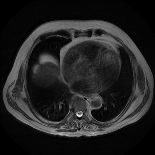 File:Acute cholecystitis complicated by pylephlebitis (Radiopaedia 65782-74915 Axial T2 1).jpg