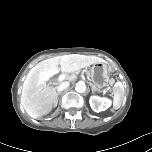 Acute cholecystitis with contained perforation (Radiopaedia 47328-51907 Axial C+ portal venous phase 21).png
