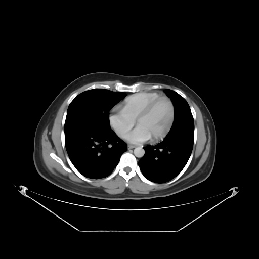 File:Acute complicated calculous cholecystitis (Radiopaedia 55202-61587 Axial C+ delayed 12).jpg