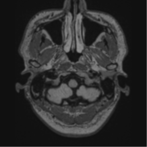 Acute disseminated encephalomyelitis (ADEM)- Anti-NMDA receptor encephalitis (Radiopaedia 54920-61201 Axial FLAIR 4).png