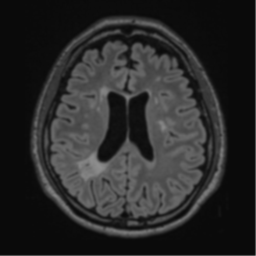 Acute disseminated encephalomyelitis (ADEM)- Anti-NMDA receptor encephalitis (Radiopaedia 54920-61201 Axial FLAIR 43).png